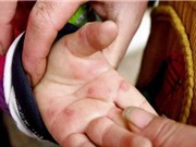 Bệnh cúm cà chua bí ẩn đang lan rộng ở trẻ em Ấn Độ